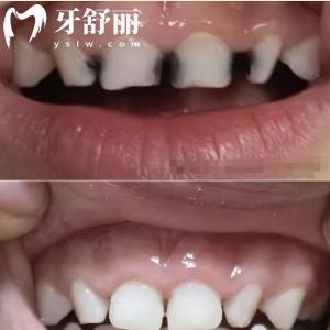兒童預成冠