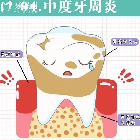 牙周炎一輩子都治不好嗎？怎么樣才能徹底根除？