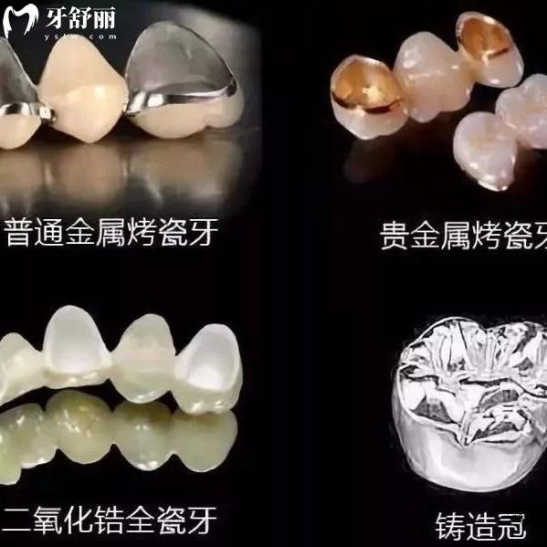 鑲一顆牙能維持多久？