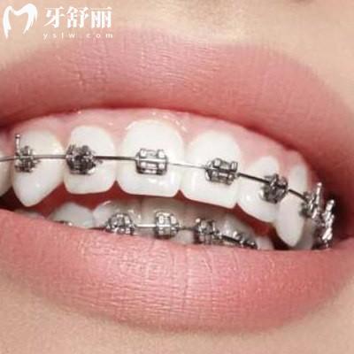 告知曲靖正規(guī)口腔醫(yī)院收費(fèi)標(biāo)準(zhǔn)是怎樣的，價(jià)目表更新包含舌側(cè)隱形矯正等項(xiàng)目