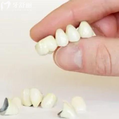 2024年現(xiàn)在換一口假牙多少錢 鑲牙種牙牙冠哪種劃算