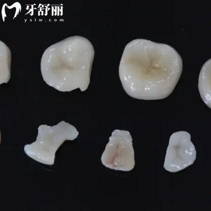 嵌體有哪些材質(zhì)？哪種比較好？
