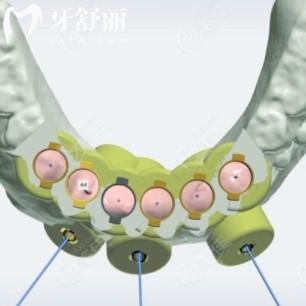 數(shù)字化種植牙和傳統(tǒng)種植牙哪個貴？