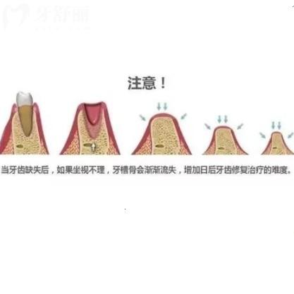 牙槽骨再生手術(shù)