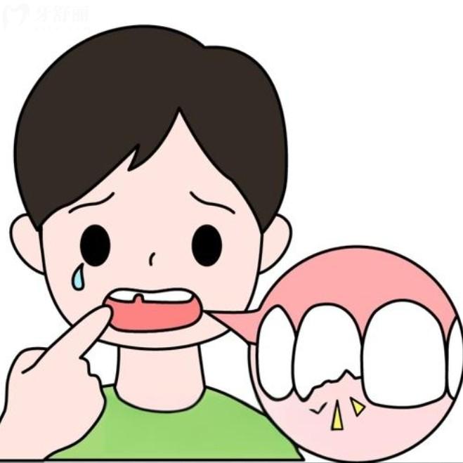 乳牙磕斷了一半怎么辦？直接拔掉還是修復(fù)？