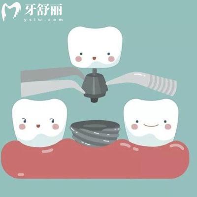 2025北京中老年人種植牙多少錢?50-70歲老人種牙集采價(jià)格1680+半口2W+