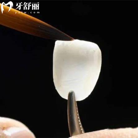 牙齒貼面時(shí)間長了會(huì)掉嗎
