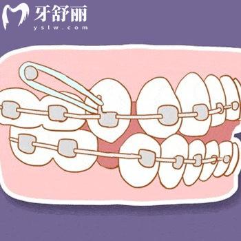 2025沈陽(yáng)口腔牙科矯正牙齒收費(fèi)標(biāo)準(zhǔn):金屬矯正6000+自鎖8K+隱形2W+半隱形1W+